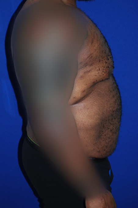Extended Abdominoplasty Before and After | Plastic Surgery Institute of Washington