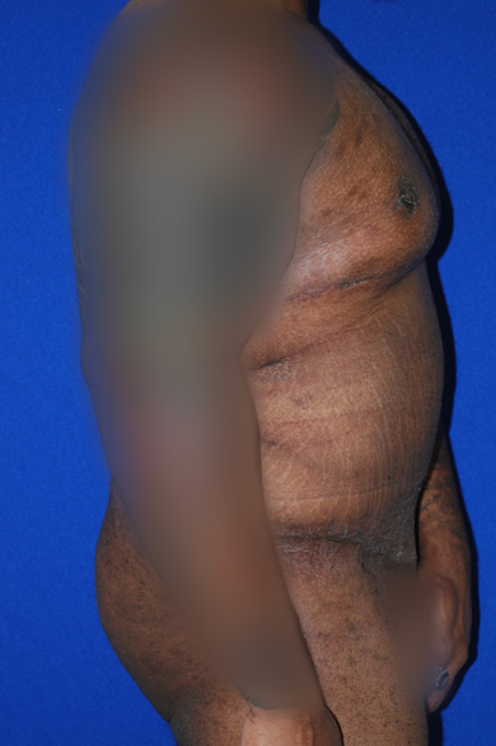 Extended Abdominoplasty Before and After | Plastic Surgery Institute of Washington