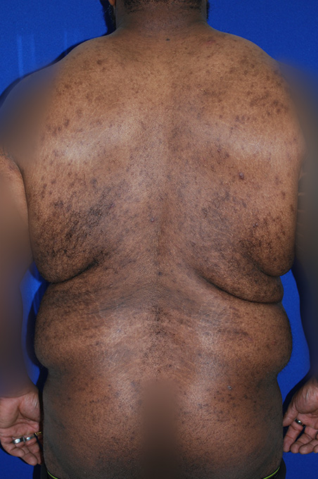 Extended Abdominoplasty Before and After | Plastic Surgery Institute of Washington