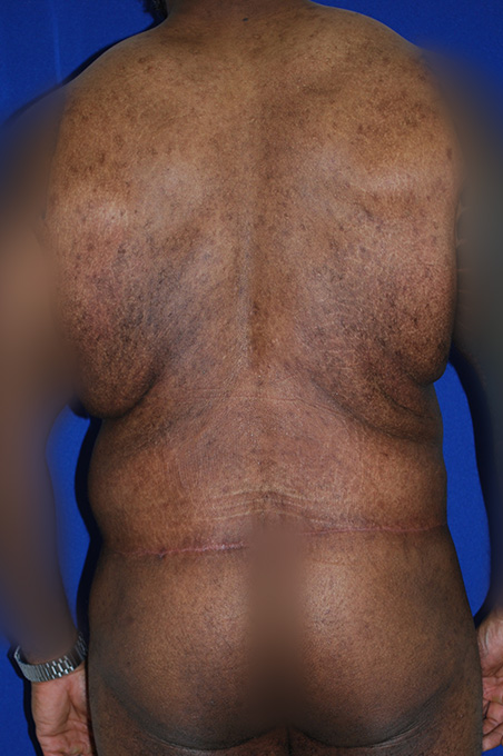 Extended Abdominoplasty Before and After | Plastic Surgery Institute of Washington