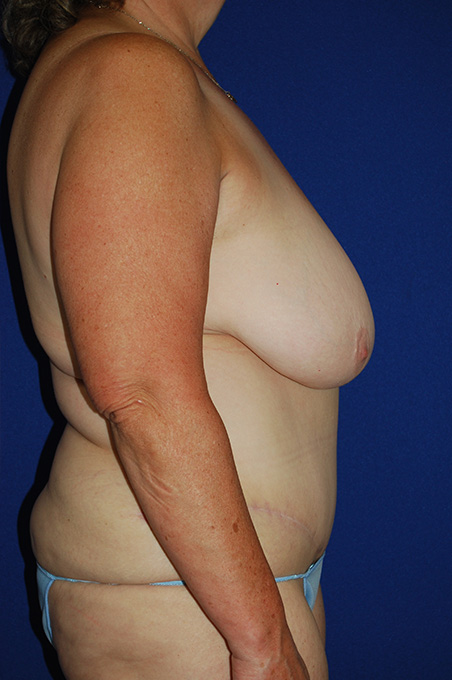 Extended Abdominoplasty Before and After | Plastic Surgery Institute of Washington
