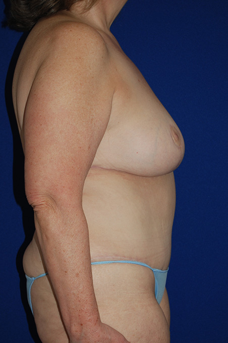 Extended Abdominoplasty Before and After | Plastic Surgery Institute of Washington