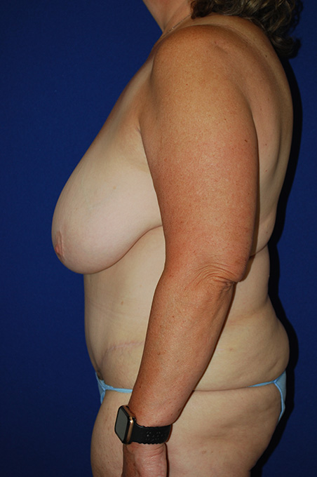 Extended Abdominoplasty Before and After | Plastic Surgery Institute of Washington