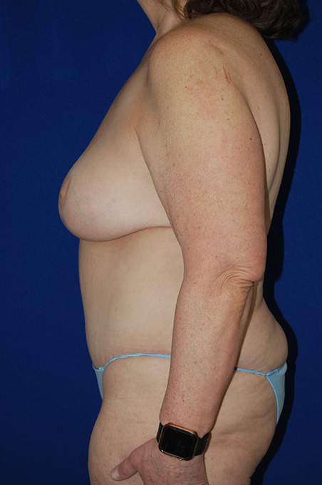 Extended Abdominoplasty Before and After | Plastic Surgery Institute of Washington