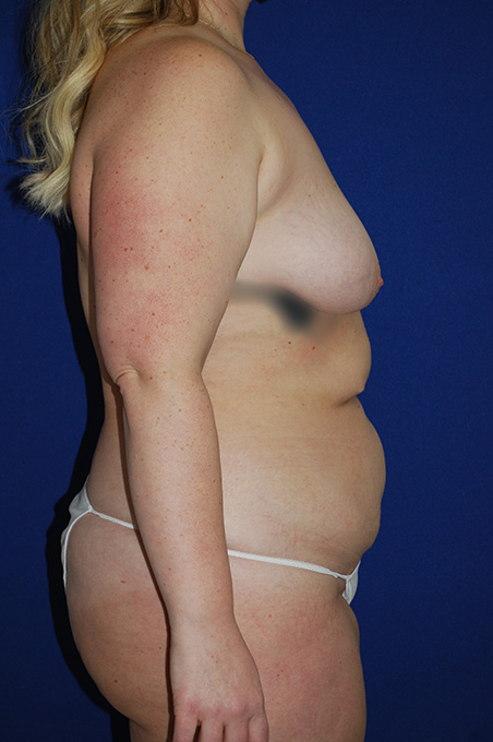 Extended Abdominoplasty Before and After | Plastic Surgery Institute of Washington