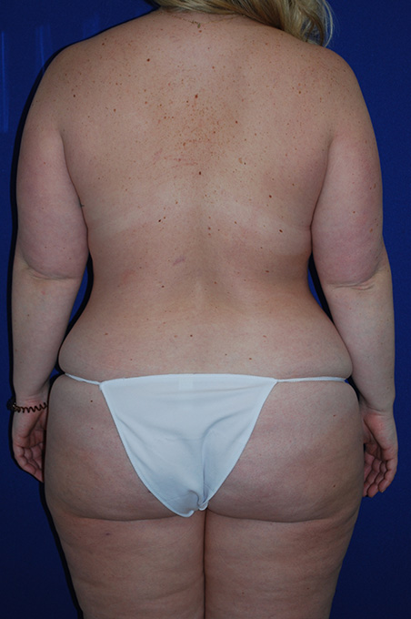 Extended Abdominoplasty Before and After | Plastic Surgery Institute of Washington
