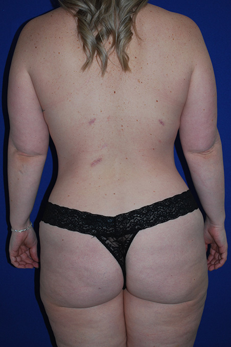 Extended Abdominoplasty Before and After | Plastic Surgery Institute of Washington