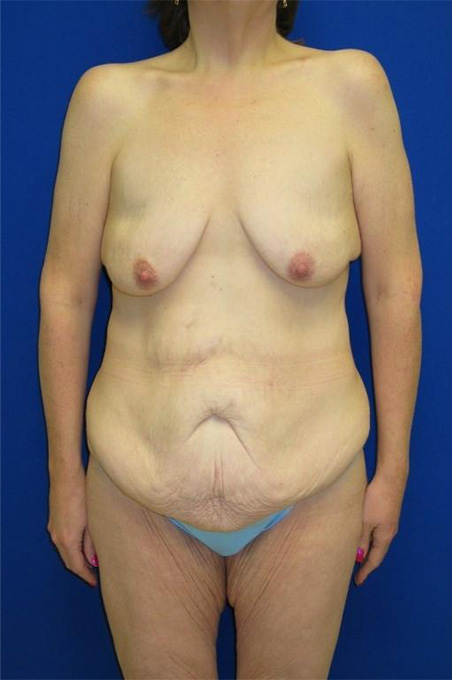 Extended Abdominoplasty Before and After | Plastic Surgery Institute of Washington
