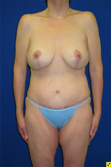 Extended Abdominoplasty Before and After | Plastic Surgery Institute of Washington