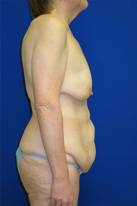Extended Abdominoplasty Before and After | Plastic Surgery Institute of Washington
