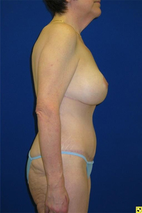 Extended Abdominoplasty Before and After | Plastic Surgery Institute of Washington