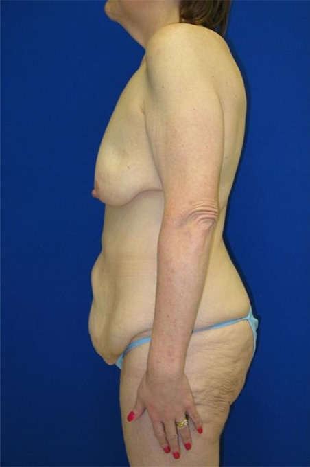 Extended Abdominoplasty Before and After | Plastic Surgery Institute of Washington