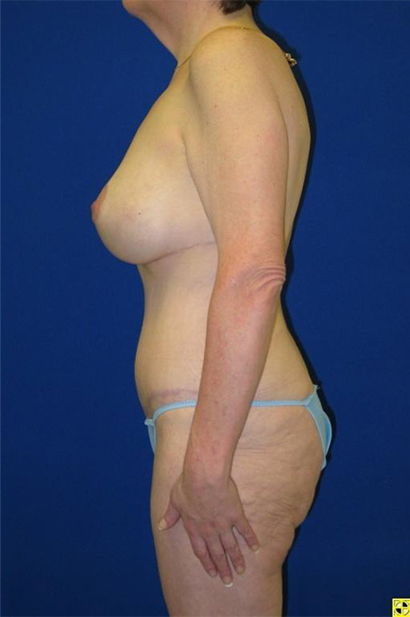 Extended Abdominoplasty Before and After | Plastic Surgery Institute of Washington