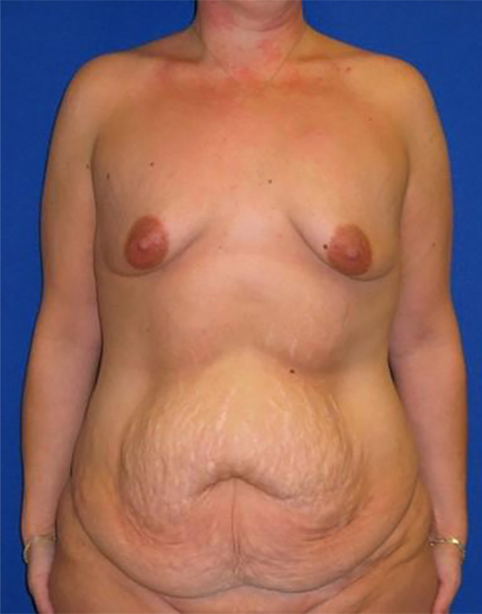 Extended Abdominoplasty Before and After | Plastic Surgery Institute of Washington