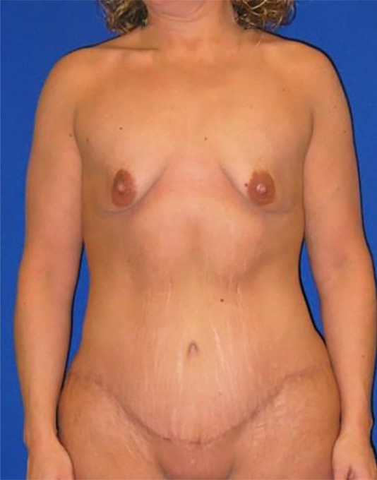 Extended Abdominoplasty Before and After | Plastic Surgery Institute of Washington