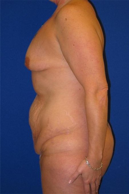 Extended Abdominoplasty Before and After | Plastic Surgery Institute of Washington