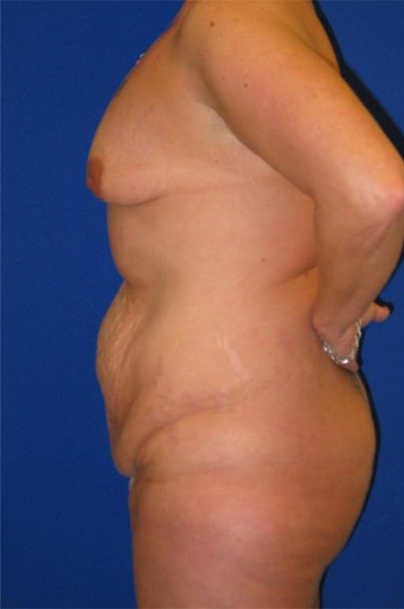 Extended Abdominoplasty Before and After | Plastic Surgery Institute of Washington