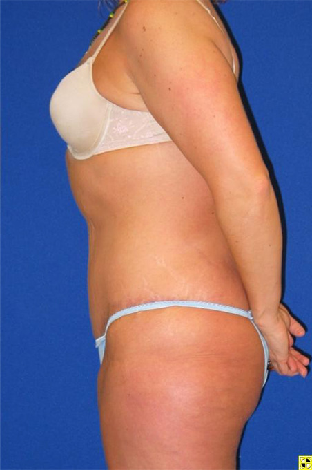 Extended Abdominoplasty Before and After | Plastic Surgery Institute of Washington
