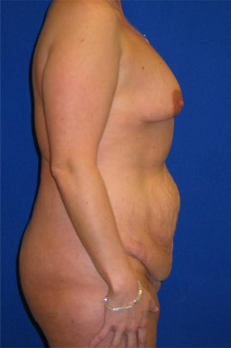 Extended Abdominoplasty Before and After | Plastic Surgery Institute of Washington
