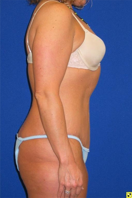 Extended Abdominoplasty Before and After | Plastic Surgery Institute of Washington