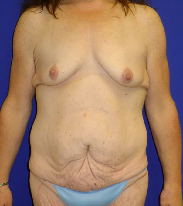 Extended Abdominoplasty Before and After | Plastic Surgery Institute of Washington