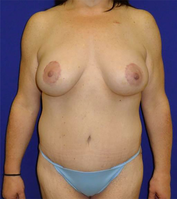 Extended Abdominoplasty Before and After | Plastic Surgery Institute of Washington
