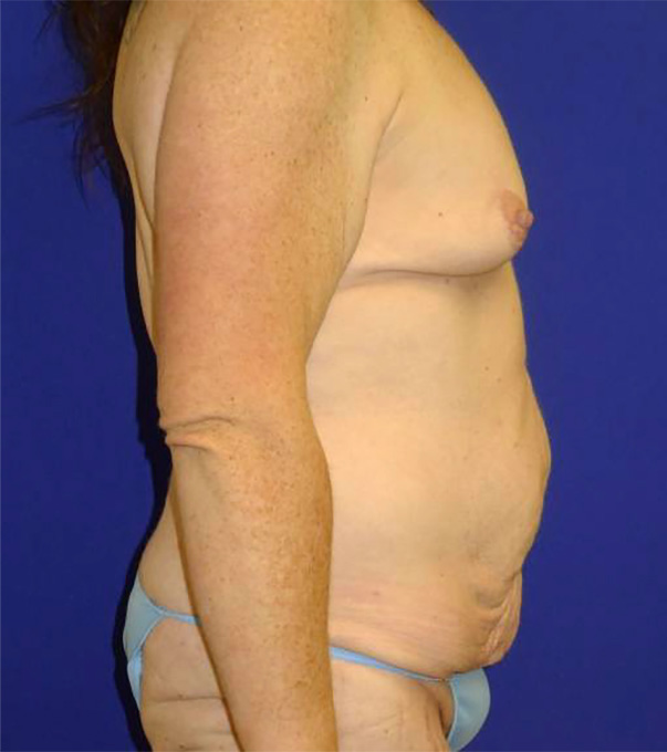 Extended Abdominoplasty Before and After | Plastic Surgery Institute of Washington