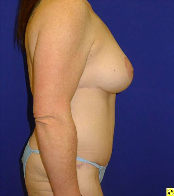 Extended Abdominoplasty Before and After | Plastic Surgery Institute of Washington