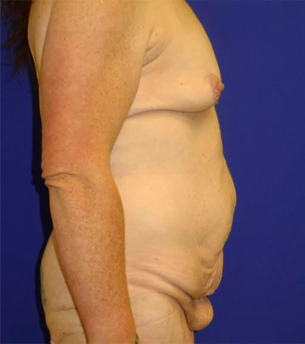 Extended Abdominoplasty Before and After | Plastic Surgery Institute of Washington