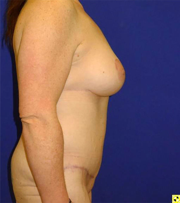 Extended Abdominoplasty Before and After | Plastic Surgery Institute of Washington
