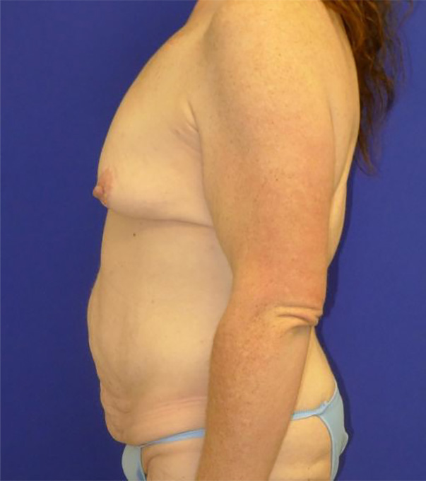 Extended Abdominoplasty Before and After | Plastic Surgery Institute of Washington