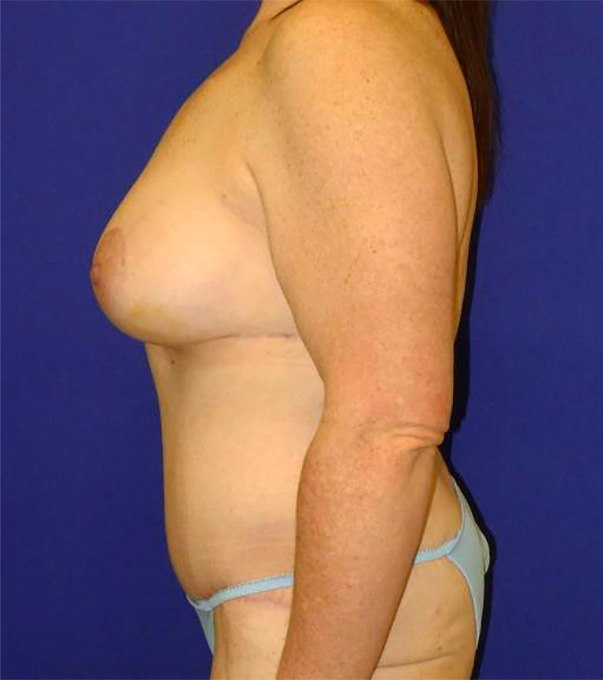 Extended Abdominoplasty Before and After | Plastic Surgery Institute of Washington