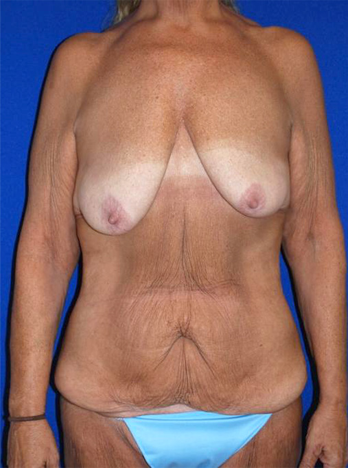 Extended Abdominoplasty Before and After | Plastic Surgery Institute of Washington