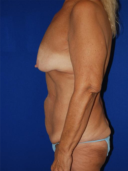 Extended Abdominoplasty Before and After | Plastic Surgery Institute of Washington