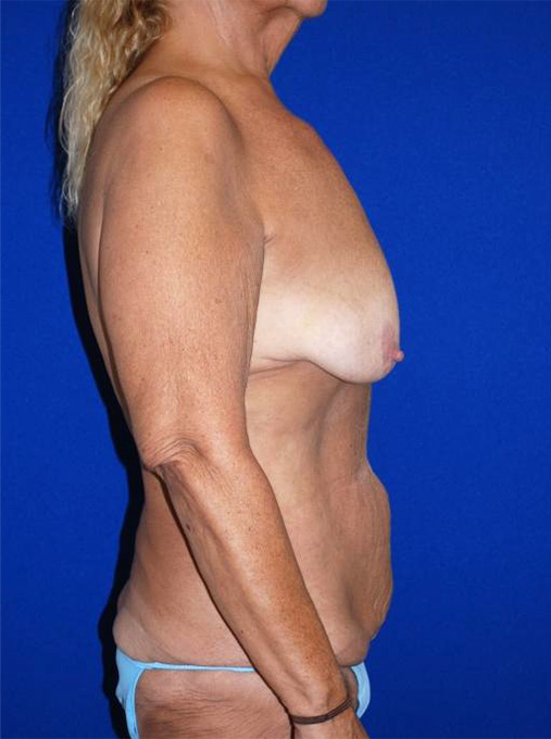 Extended Abdominoplasty Before and After | Plastic Surgery Institute of Washington
