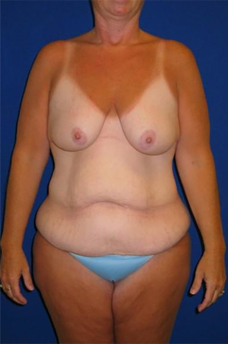 Extended Abdominoplasty Before and After | Plastic Surgery Institute of Washington