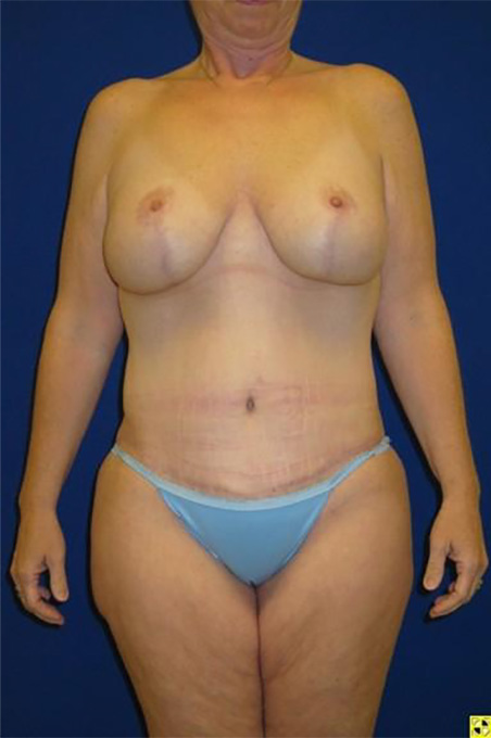 Extended Abdominoplasty Before and After | Plastic Surgery Institute of Washington