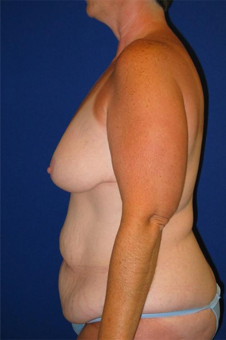 Extended Abdominoplasty Before and After | Plastic Surgery Institute of Washington