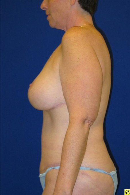 Extended Abdominoplasty Before and After | Plastic Surgery Institute of Washington