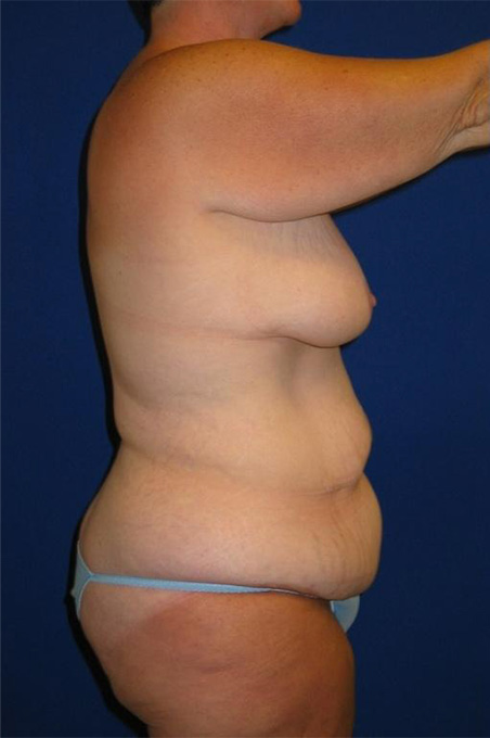 Extended Abdominoplasty Before and After | Plastic Surgery Institute of Washington