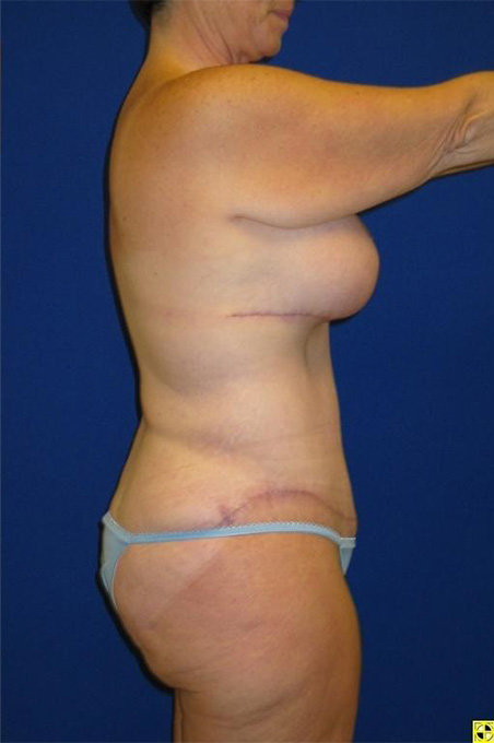 Extended Abdominoplasty Before and After | Plastic Surgery Institute of Washington