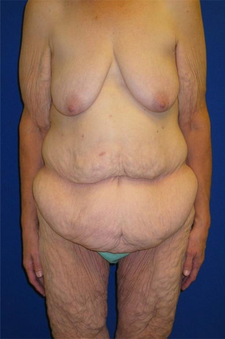 Extended Abdominoplasty Before and After | Plastic Surgery Institute of Washington