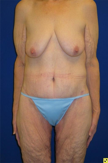 Extended Abdominoplasty Before and After | Plastic Surgery Institute of Washington