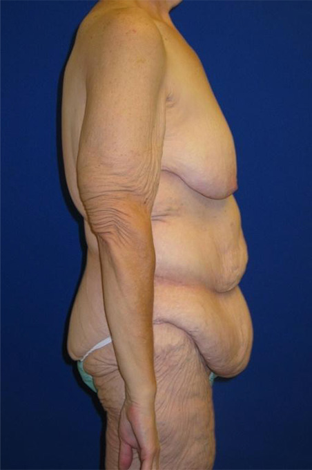 Extended Abdominoplasty Before and After | Plastic Surgery Institute of Washington