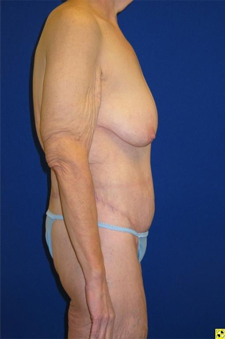 Extended Abdominoplasty Before and After | Plastic Surgery Institute of Washington