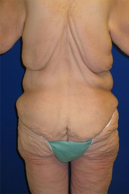 Extended Abdominoplasty Before and After | Plastic Surgery Institute of Washington