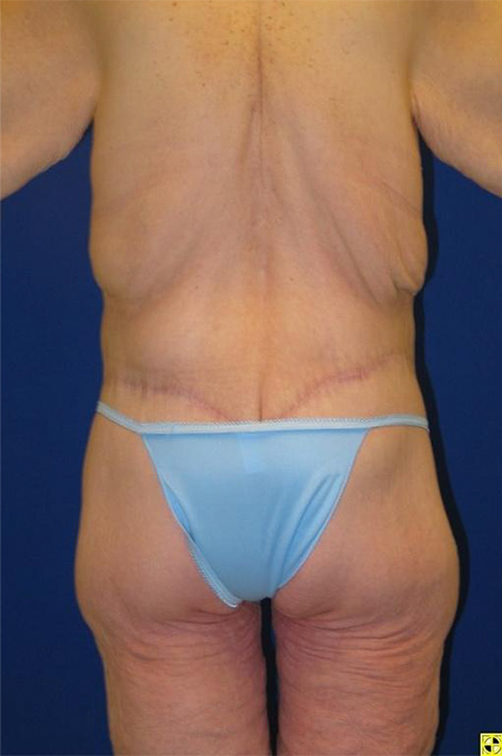 Extended Abdominoplasty Before and After | Plastic Surgery Institute of Washington