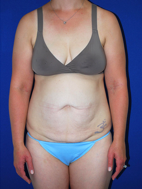 Extended Abdominoplasty Before and After | Plastic Surgery Institute of Washington