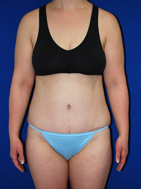 Extended Abdominoplasty Before and After | Plastic Surgery Institute of Washington