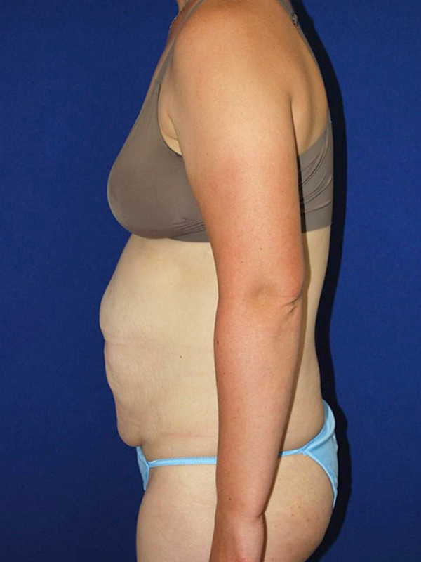 Extended Abdominoplasty Before and After | Plastic Surgery Institute of Washington